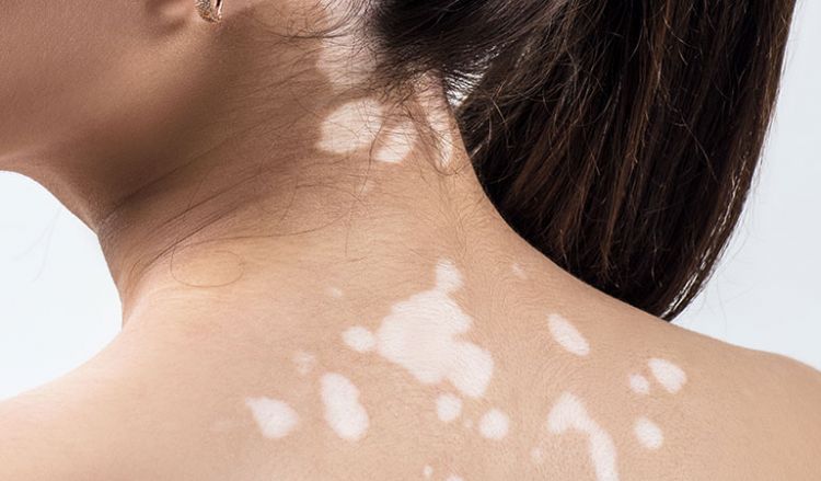 You need not be ashamed to flaunt your skin anymore! Treat vitiligo with homeopathy