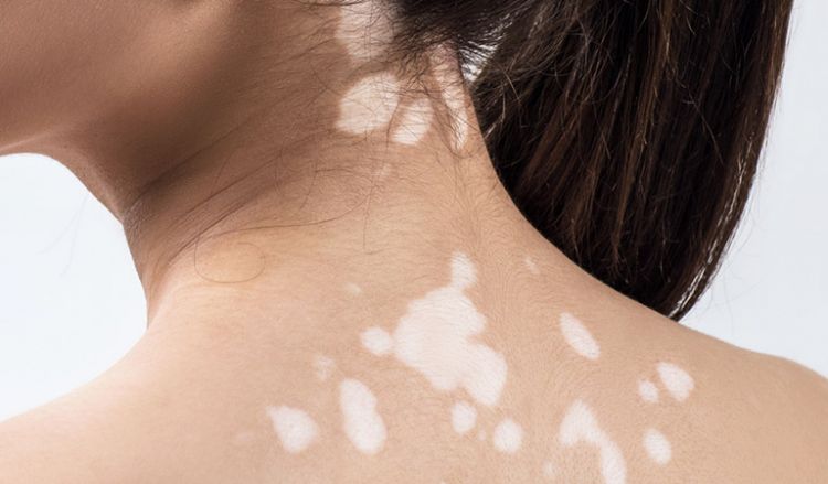 One-stop solution for your white spots – Homeopathy | Dr Batra's™ One-stop solution for your white spots – Homeopathy | Dr Batra's™