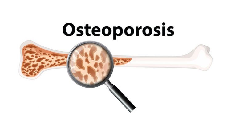 HOMEOPATHY & OSTEOPOROSIS