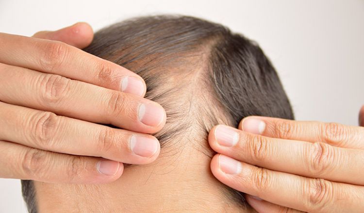 How can Homoeopathy help me with my thinning hair?