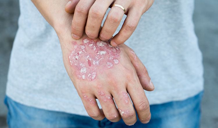 Combination of treatment plans for severe psoriasis