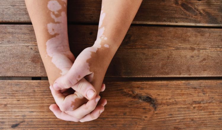 Homeopathy: Natural and holistic approach for Vitiligo