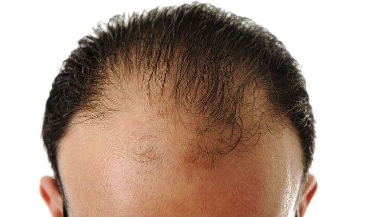 MALE PATTERN BALDNESS SYMPTOMS & PREVENTION | Dr Batra's™ MALE PATTERN BALDNESS SYMPTOMS & PREVENTION | Dr Batra's™