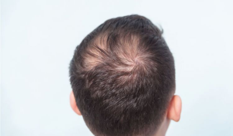 Male pattern baldness Expert shares some common causes  Lifestyle  NewsThe Indian Express