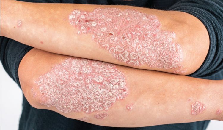 Skin rash? It might be Psoriasis