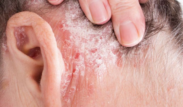 Know the 10 complications of psoriasis