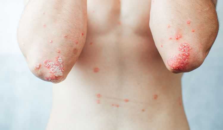 Eczema vs Psoriasis — Know the difference.