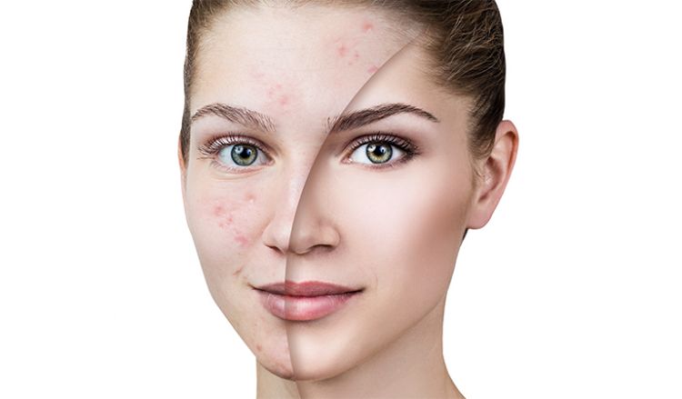 Homeopathy — Best Remedy for Acne.
