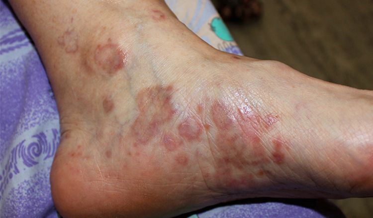 Lichen Planus & Depression — What's the Connection?
