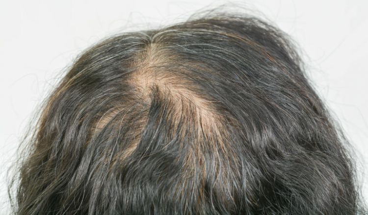 Thinning hair? Choose Homeopathy