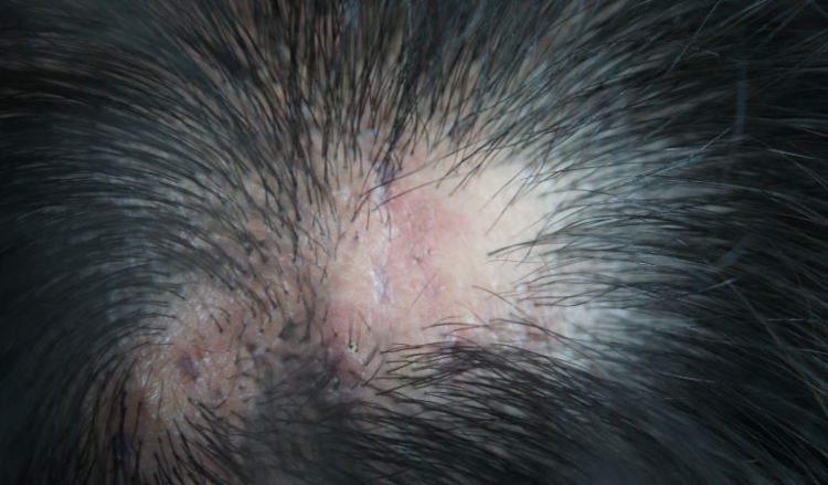 Lichen planus and hair loss
