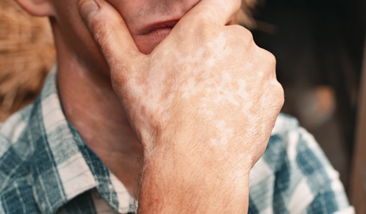 Is vitiligo an autoimmune disease?