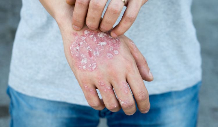 autoimmune psoriasis adalah