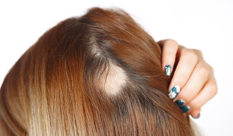 Can Alopecia Areata turn into totalis?