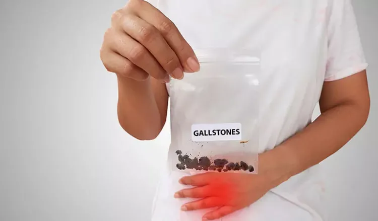 Roll out gallstones using homeopathy