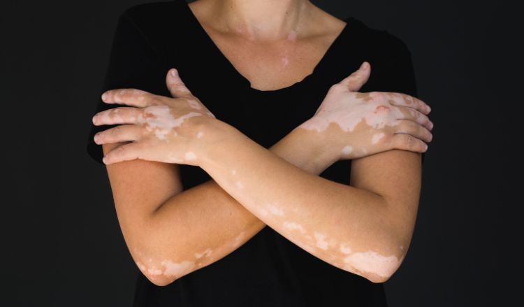 How to stop getting new vitiligo patches?