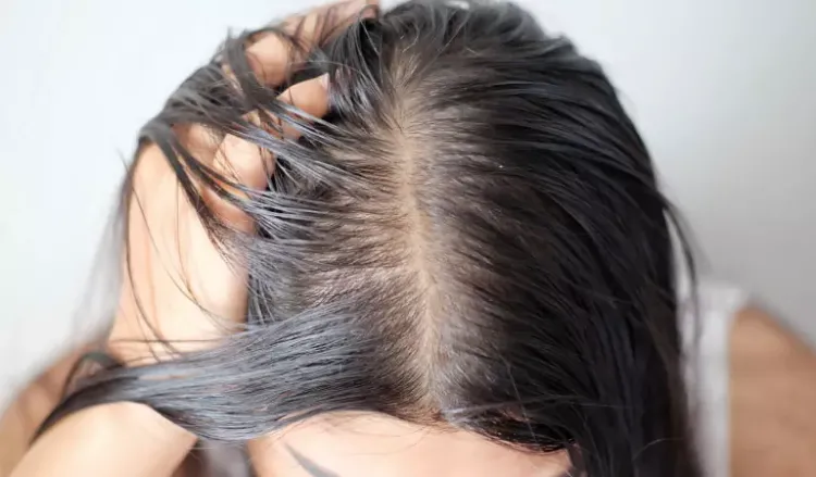 Female Pattern Baldness in your 20s?