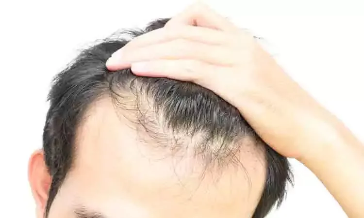 Answering Questions on Scalp Lichen Planus
