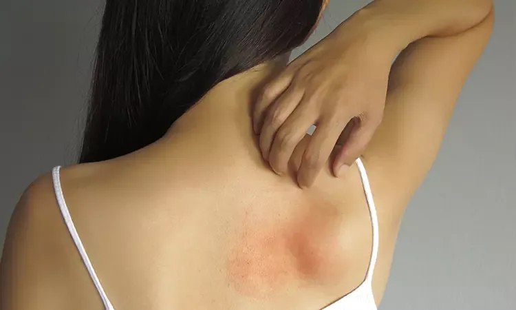  Get rid of Lichen Planus with Homeopathy Treatment