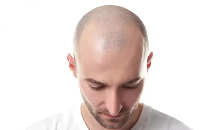 Homeopathy Effectively Treats Alopecia Totalis