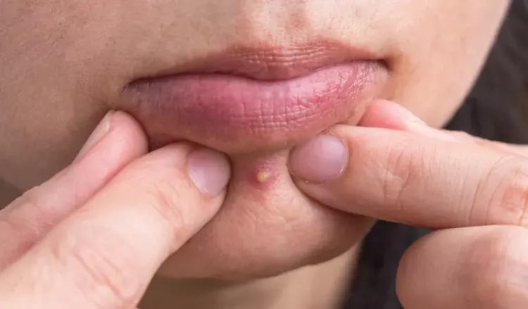 Can popping a pimple lead to acne scars?