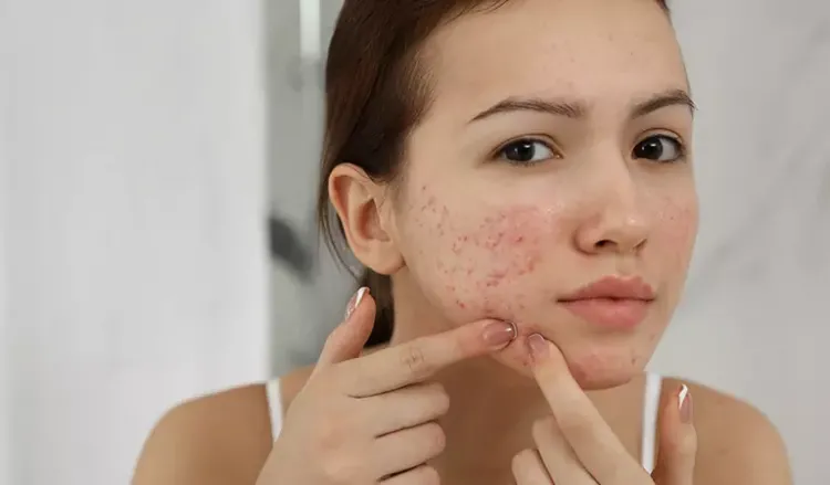 All you need to know about severe acne.
