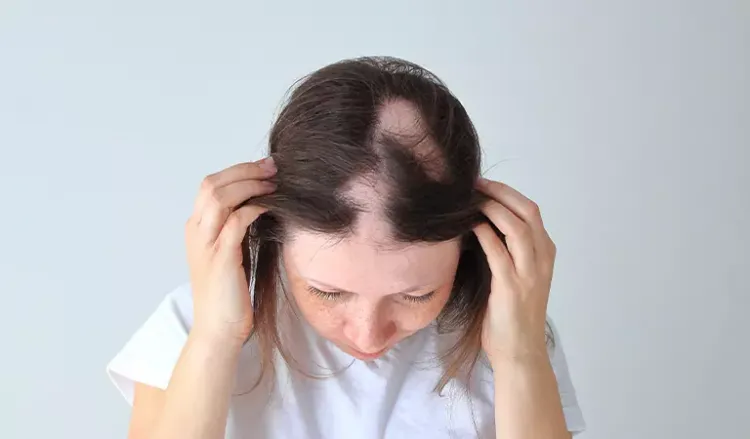 Alopecia Treatment in Homeopathy