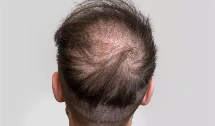 Hair loss most common in summer fall