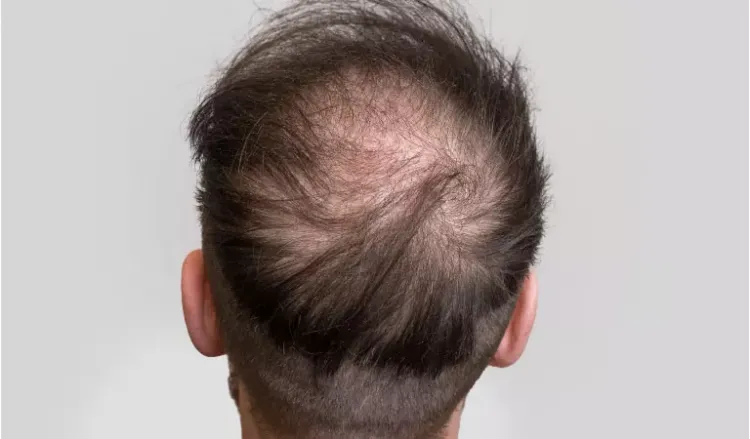 10 Things to Know About Male Pattern Baldness - Dr. Batra's®