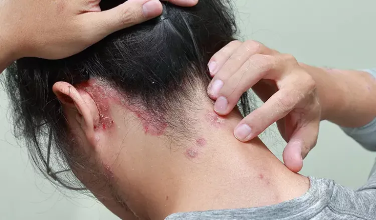 Best Shampoos For Scalp Psoriasis Dr Batra s