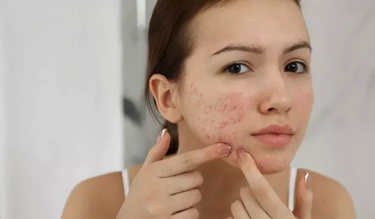Can summer and heat cause acne breakouts?