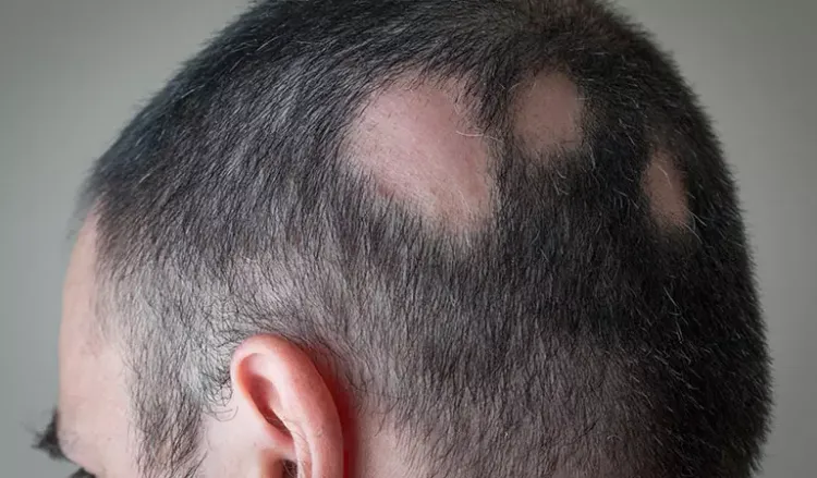 Early signs of alopecia areata