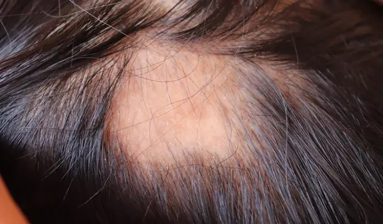 Facts about patchy hair loss