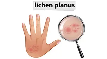 Heal your Lichen Planus symptoms with Homeopathy