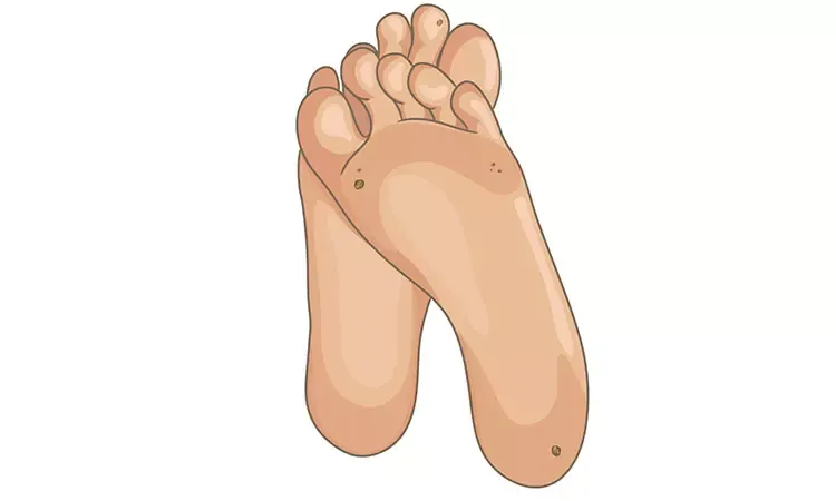 Homeopathic Treatment for Warts Removal