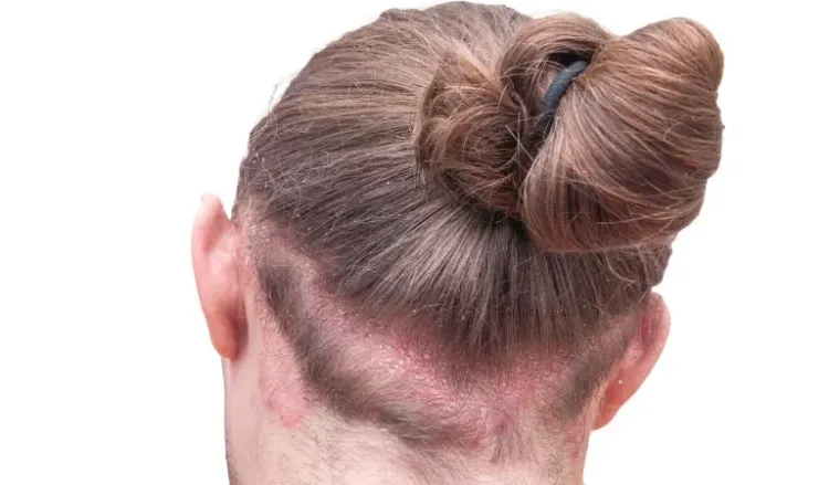Can scalp psoriasis cause red spots?