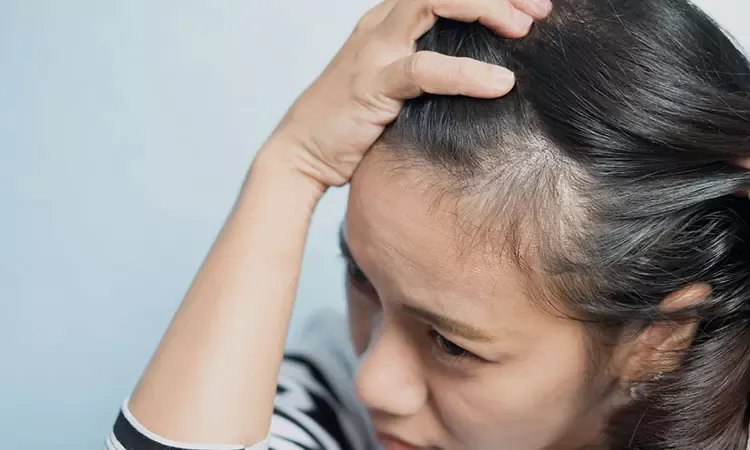 Hair Loss (Alopecia Areata) Condition, Treatments and Pictures for Teens -  Skinsight