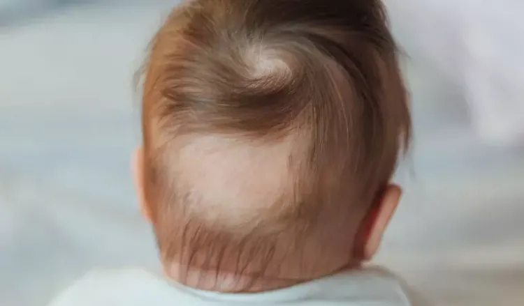 Alopecia Areata in Children - Signs & Treatment