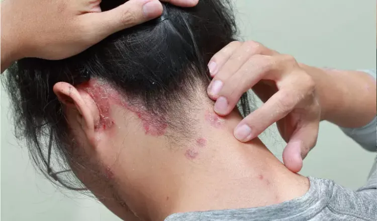 Can homeopathy treatment help scalp psoriasis?