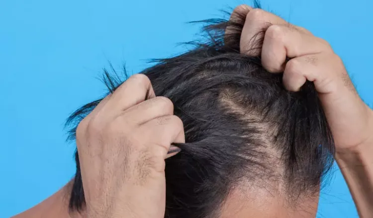 Hair pulling disorder: Causes & Treatments