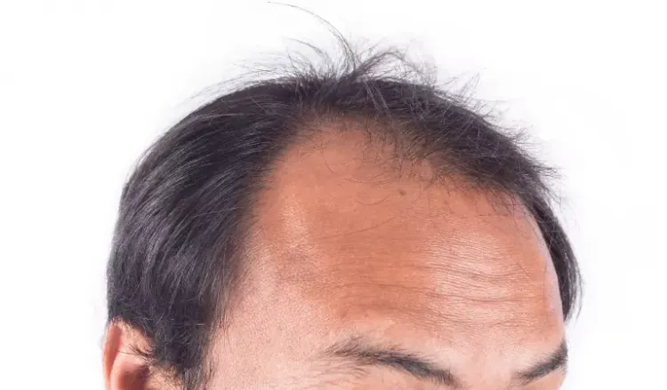 Best 15 Self-Help Tips for Male Pattern Baldness