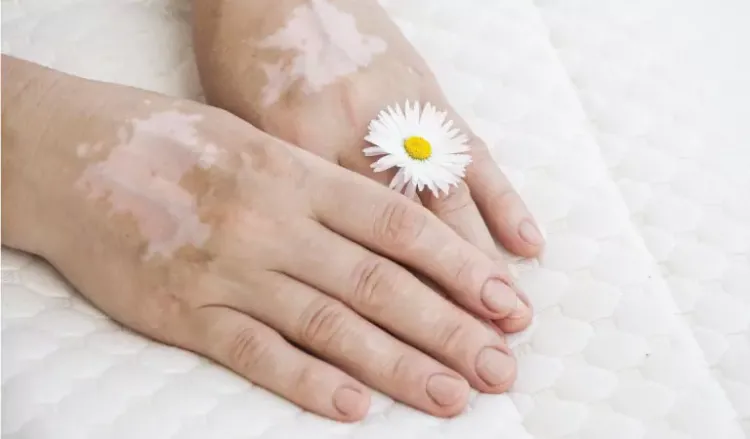 All you need to know about vitiligo