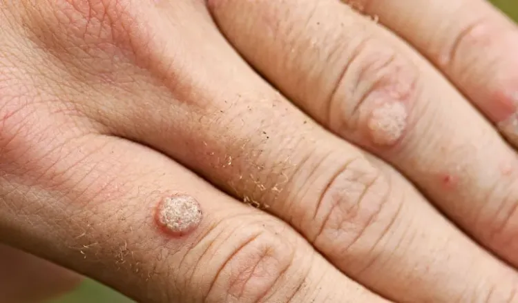 Get rid of warts with homeopathy