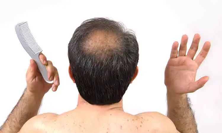 10 Common Reasons for Hair Loss in Men