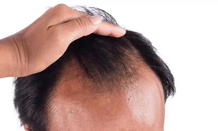 Losing hair quite often? Try Homeopathy Losing hair quite often? Try Homeopathy