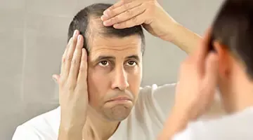 3 things you should know about male pattern baldness 