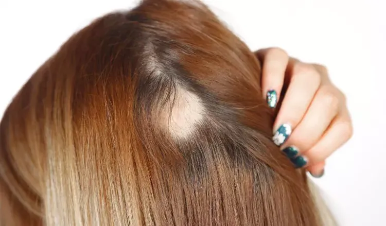 Know what it's like to have alopecia