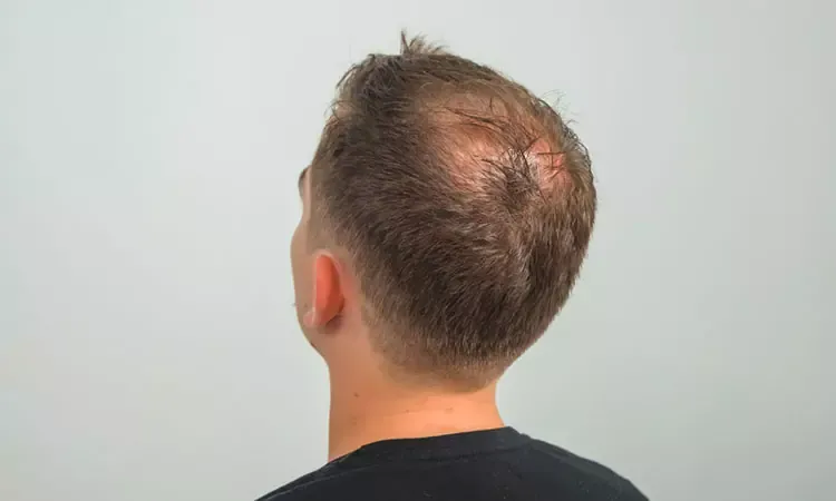 Male pattern baldness? Here are 5 effective ways to help you manage better.  | Dr Batra's™