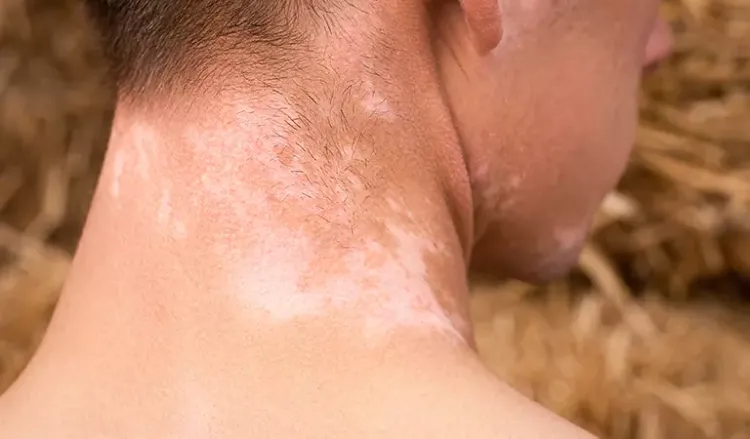5 ways to stop vitiligo from spreading