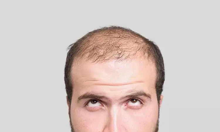 What Causes Hair Loss in Women Causes  Treatments  Philip Kingsley  Hair  Guide